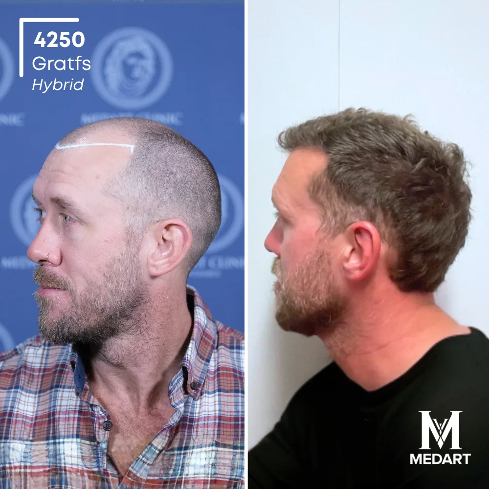 Jacop Kieran Hybride haartransplantatie voor-en-na-foto 3, 4250 grafts bij Medart Hair
