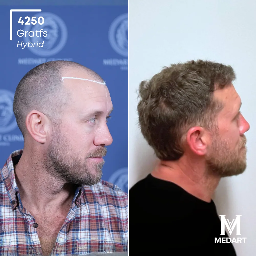 Jacop Kieran Hybride haartransplantatie voor-en-na-foto 4, 4250 grafts bij Medart Hair