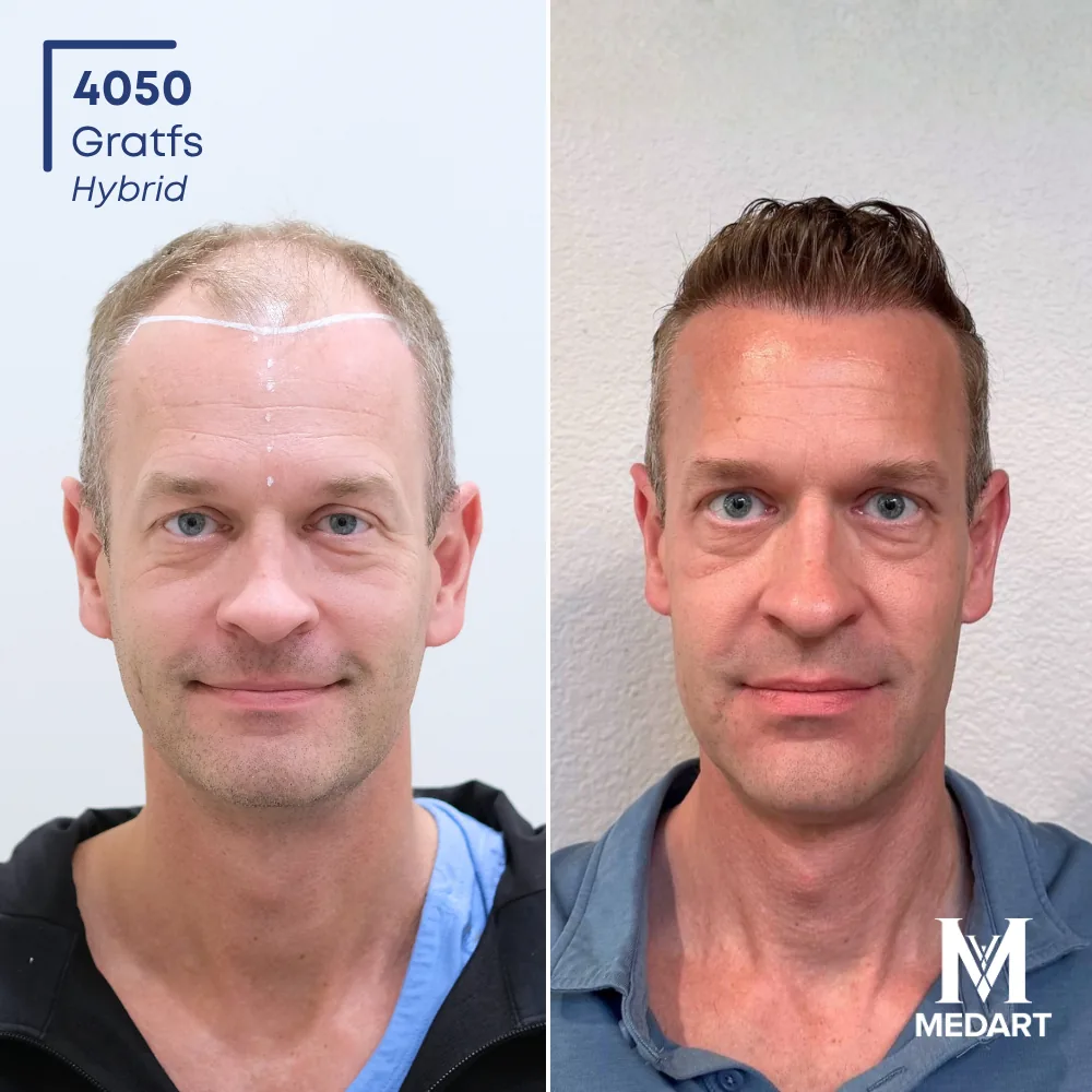Joe Hybride haartransplantatie voor-en-na-foto 1, 4050 grafts bij Medart Hair