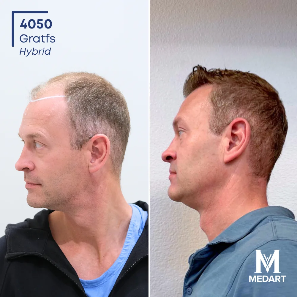 Joe Hybride haartransplantatie voor-en-na-foto 2, 4050 grafts bij Medart Hair