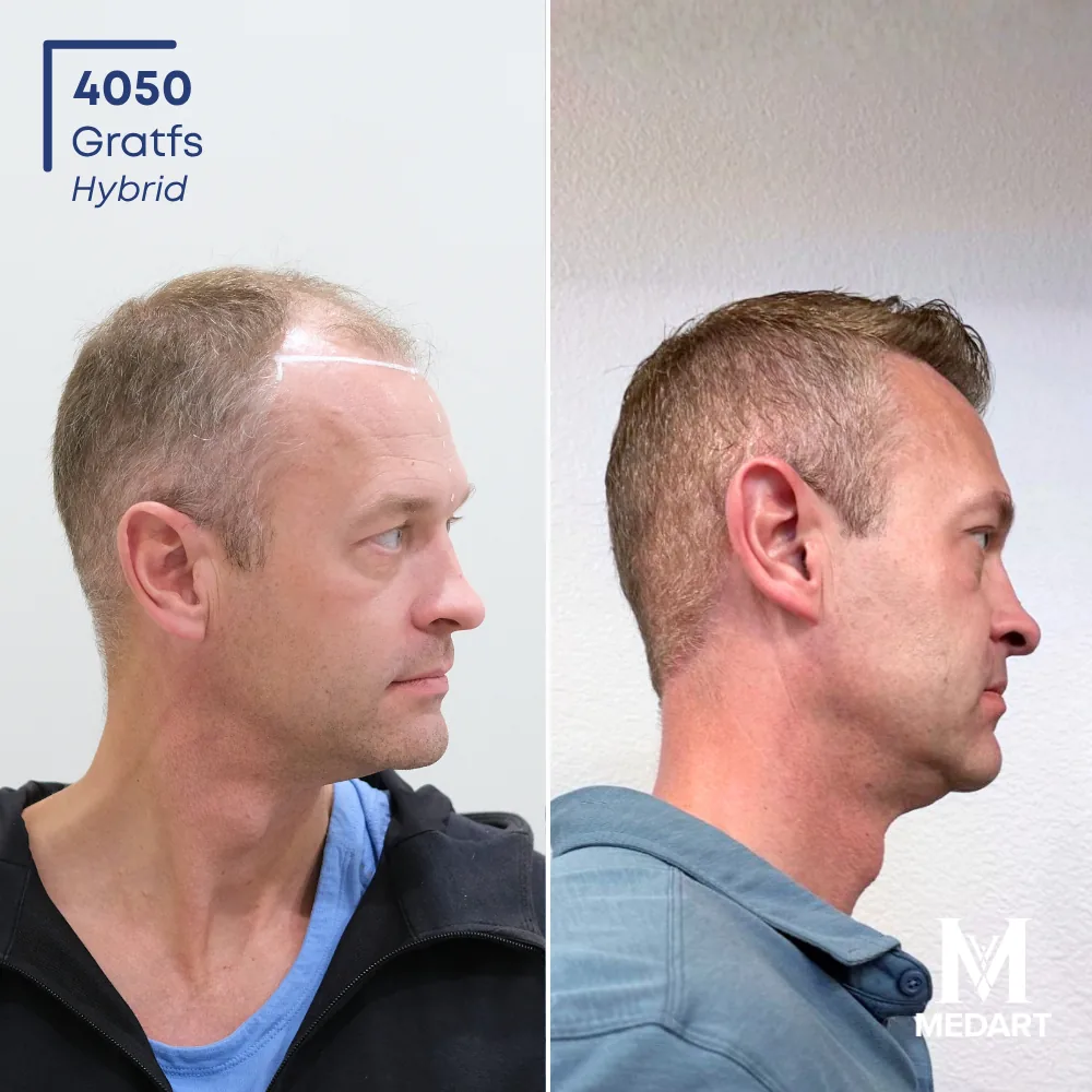 Joe Hybride haartransplantatie voor-en-na-foto 3, 4050 grafts bij Medart Hair