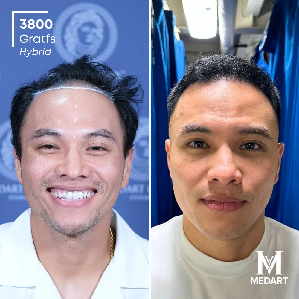 Jose Mario Hybride haartransplantatie voor-en-na-foto 1, 3800 grafts bij Medart Hair