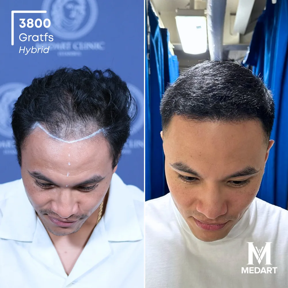 Jose Mario Hybride haartransplantatie voor-en-na-foto 2, 3800 grafts bij Medart Hair