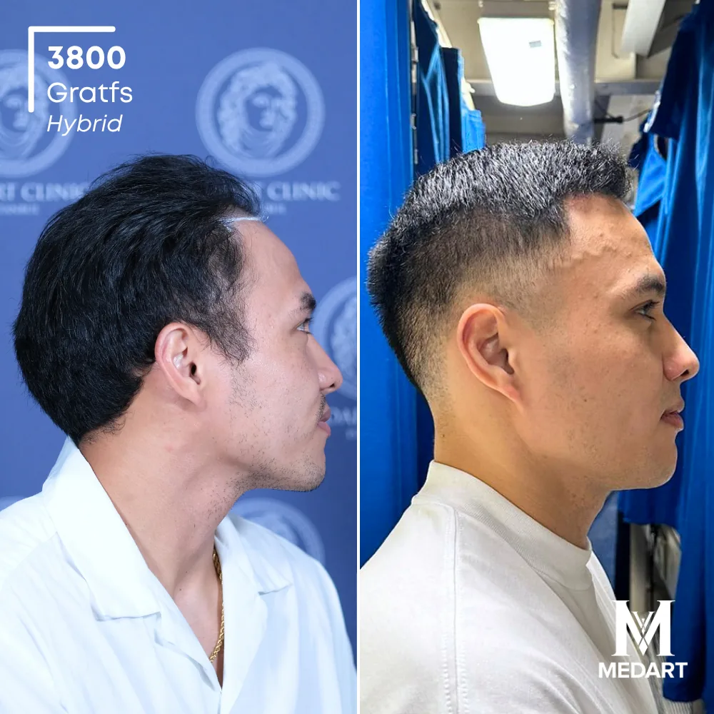Jose Mario Hybride haartransplantatie voor-en-na-foto 3, 3800 grafts bij Medart Hair