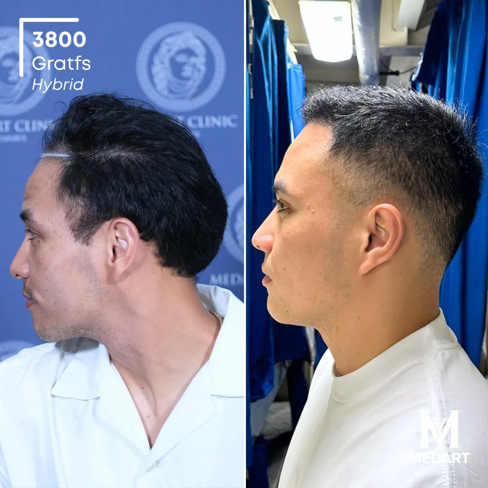 Jose Mario Hybride haartransplantatie voor-en-na-foto 4, 3800 grafts bij Medart Hair