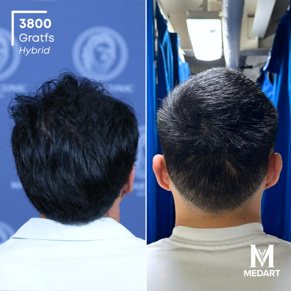Jose Mario Hybride haartransplantatie voor-en-na-foto 5, 3800 grafts bij Medart Hair
