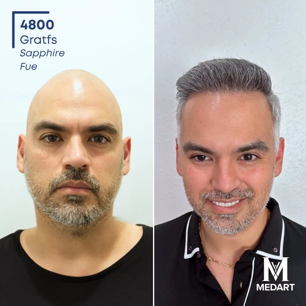 Jose Montalvo Sapphire FUE-haartransplantatie voor-en-na-foto 1, 4800 grafts bij Medart Hair
