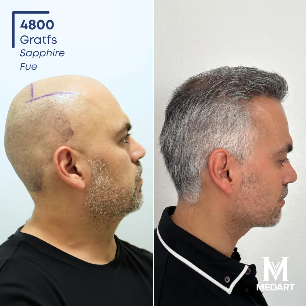 Jose Montalvo Sapphire FUE-haartransplantatie voor-en-na-foto 2, 4800 grafts bij Medart Hair