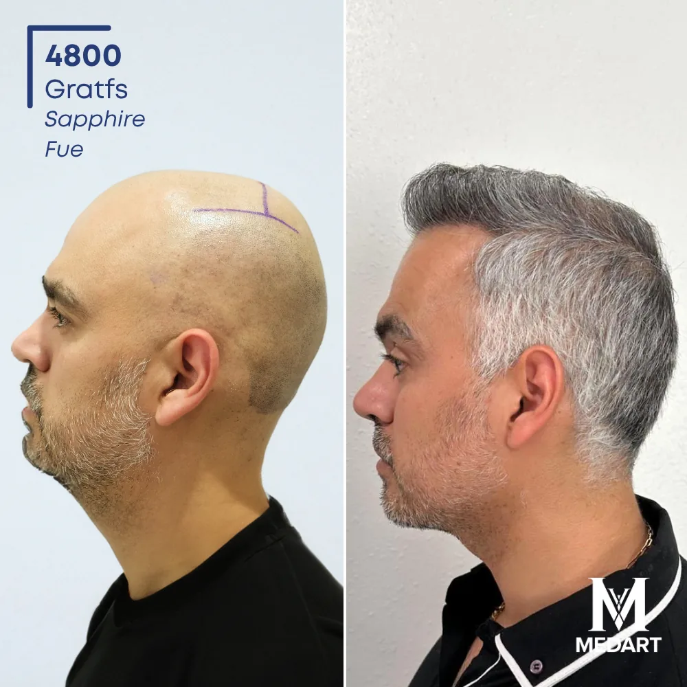 Jose Montalvo Sapphire FUE-haartransplantatie voor-en-na-foto 3, 4800 grafts bij Medart Hair