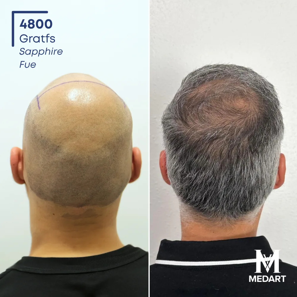 Jose Montalvo Sapphire FUE-haartransplantatie voor-en-na-foto 4, 4800 grafts bij Medart Hair