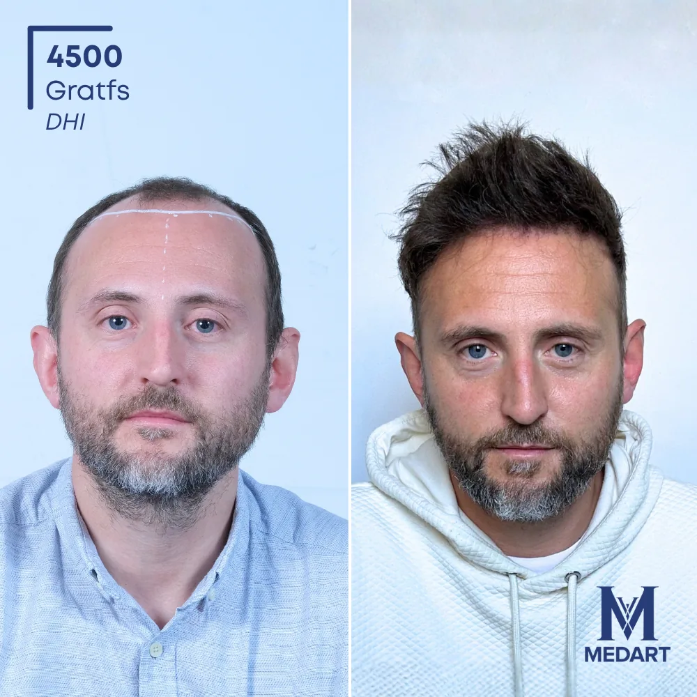 Vorher-Nachher-Foto 1 der DHI-Haartransplantation von Kenneth, 4500 Grafts bei Medart Hair
