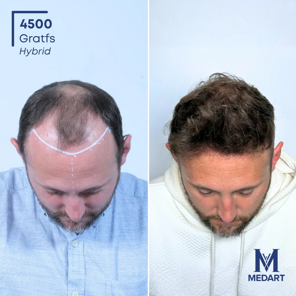 Vorher-Nachher-Foto 2 der DHI-Haartransplantation von Kenneth, 4500 Grafts bei Medart Hair