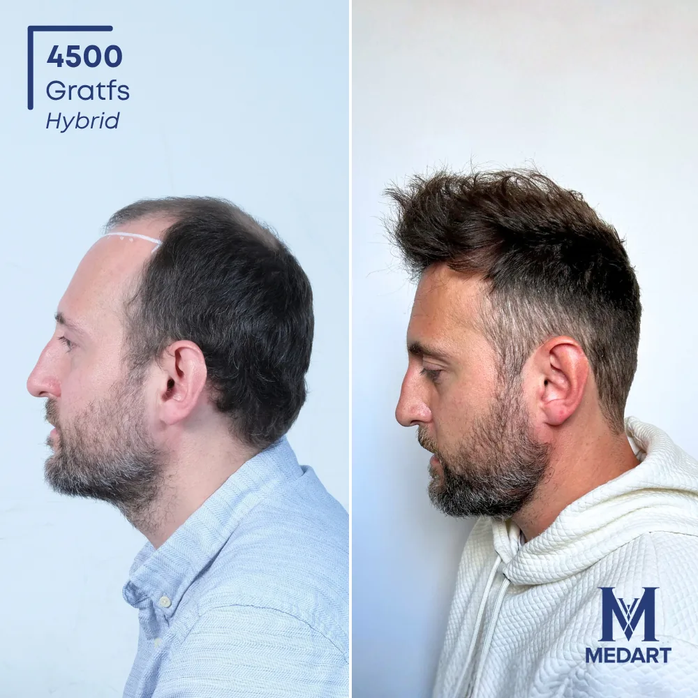 Vorher-Nachher-Foto 3 der DHI-Haartransplantation von Kenneth, 4500 Grafts bei Medart Hair
