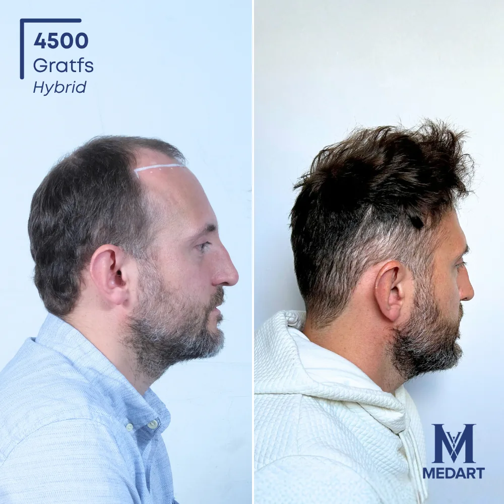 Kenneth DHI-haartransplantatie voor-en-na-foto 4, 4500 grafts bij Medart Hair