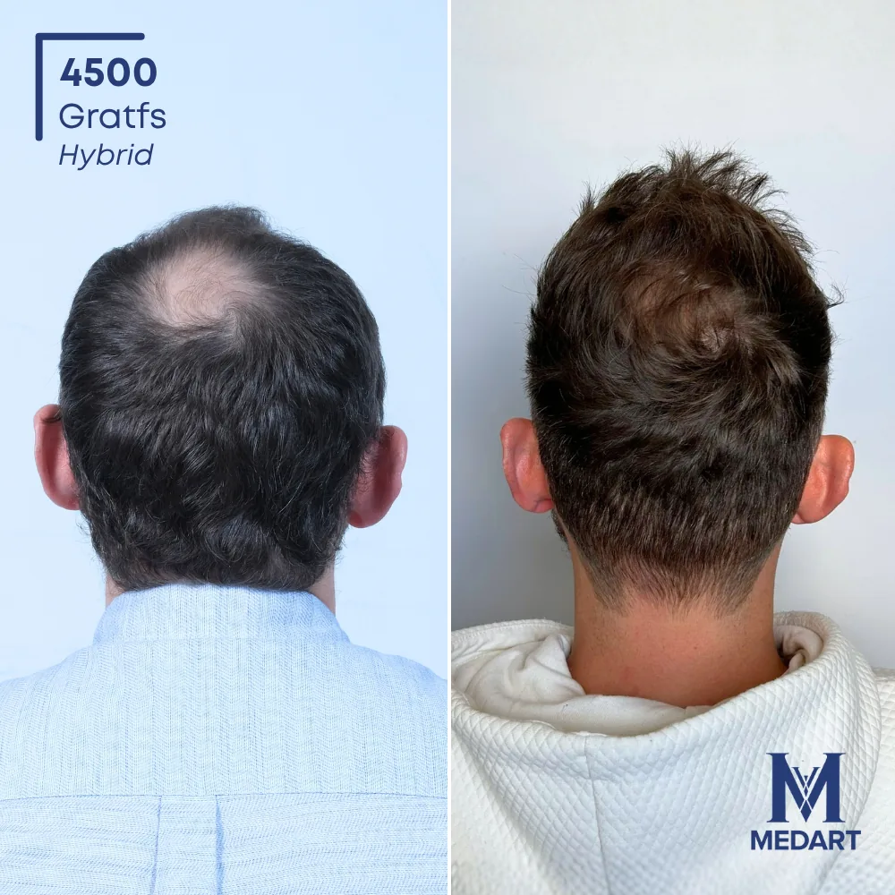 Kenneth DHI-haartransplantatie voor-en-na-foto 5, 4500 grafts bij Medart Hair