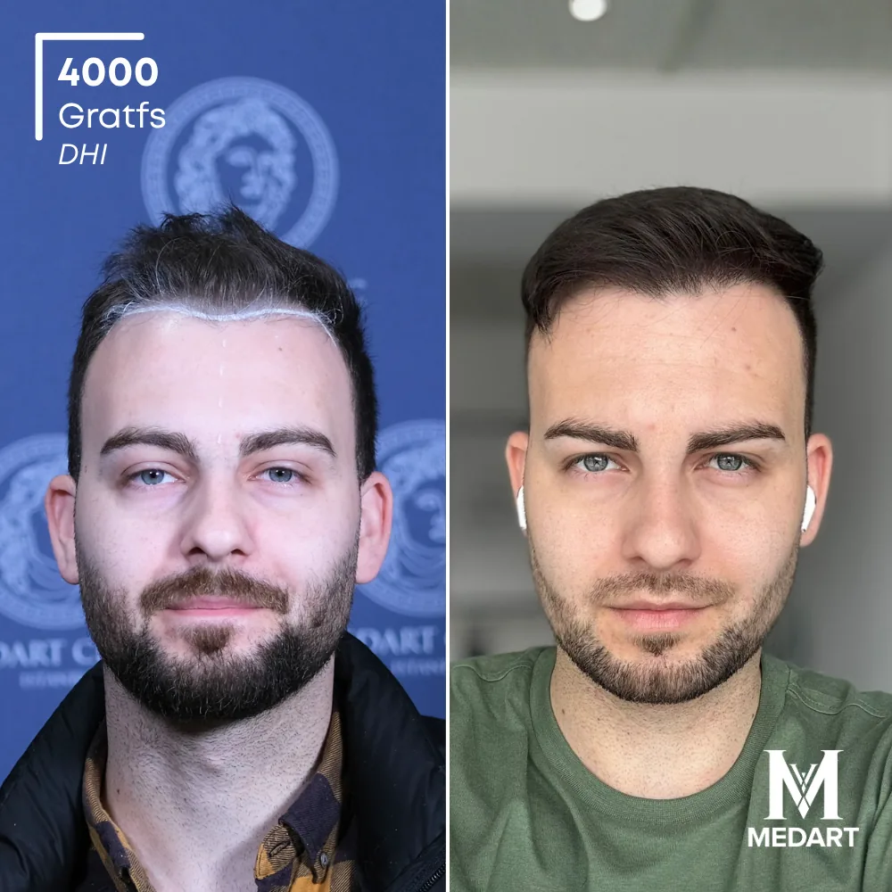 Vorher-Nachher-Foto 1 der DHI-Haartransplantation von Momchil, 4000 Grafts bei Medart Hair