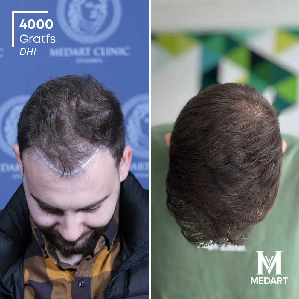 Vorher-Nachher-Foto 2 der DHI-Haartransplantation von Momchil, 4000 Grafts bei Medart Hair