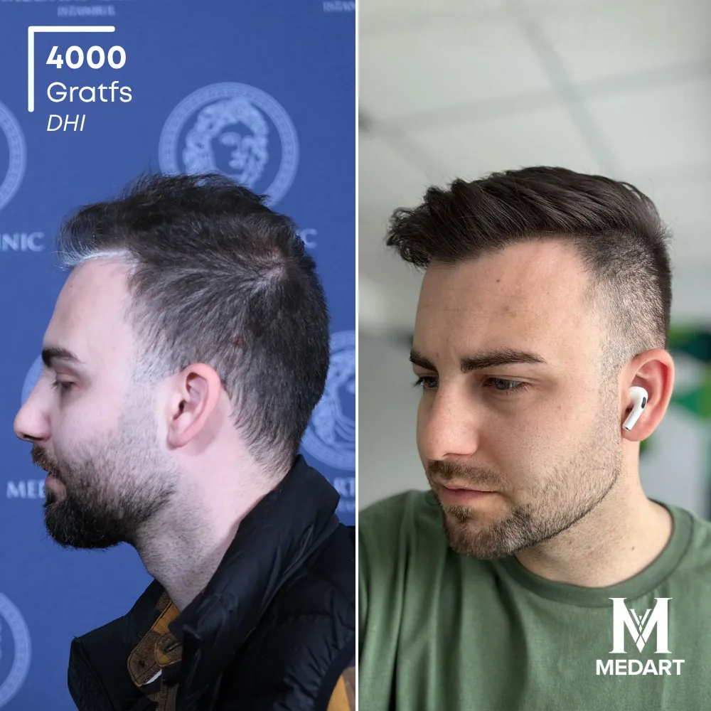 Momchil DHI-haartransplantatie voor-en-na-foto 3, 4000 grafts bij Medart Hair