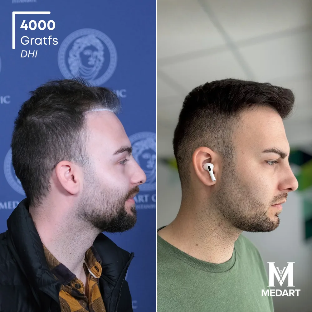 Momchil DHI-haartransplantatie voor-en-na-foto 4, 4000 grafts bij Medart Hair