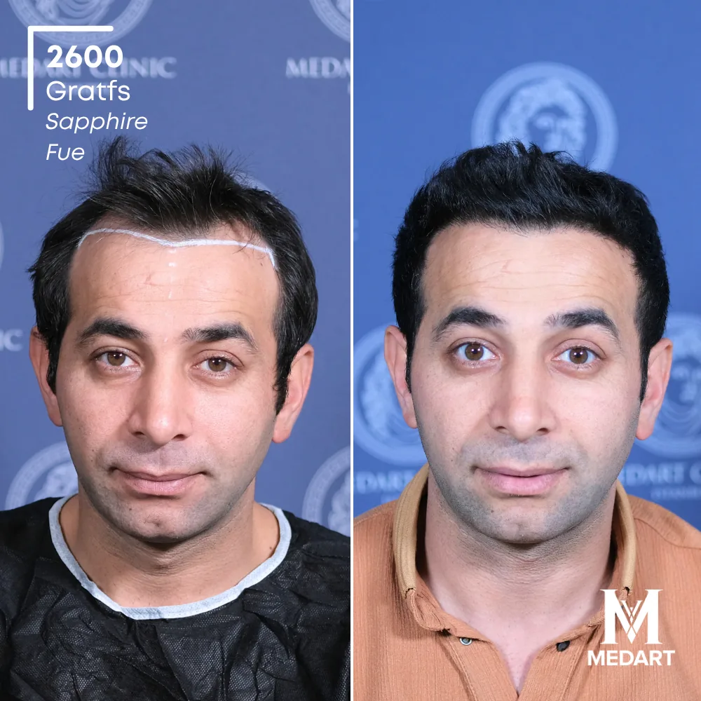 Mustafa Demirci Sapphire FUE-haartransplantatie voor-en-na-foto 1, 2600 grafts bij Medart Hair