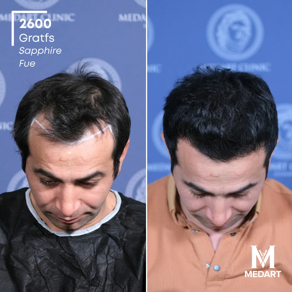 Mustafa Demirci Sapphire FUE-haartransplantatie voor-en-na-foto 2, 2600 grafts bij Medart Hair