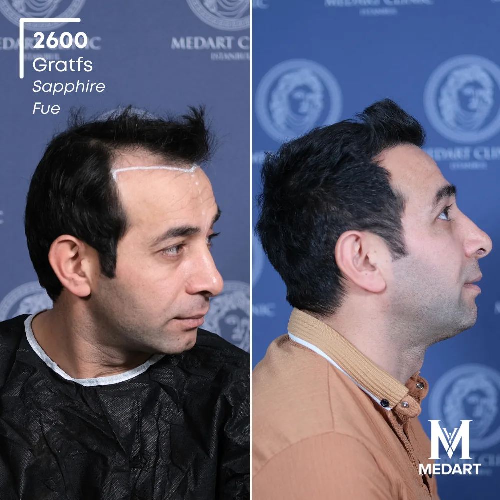 Mustafa Demirci Sapphire FUE-haartransplantatie voor-en-na-foto 3, 2600 grafts bij Medart Hair
