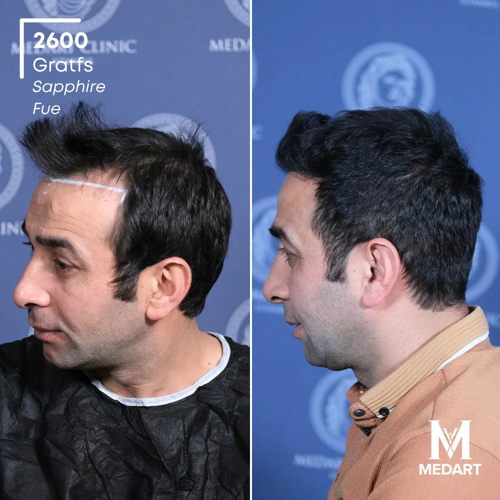 Mustafa Demirci Sapphire FUE-haartransplantatie voor-en-na-foto 4, 2600 grafts bij Medart Hair