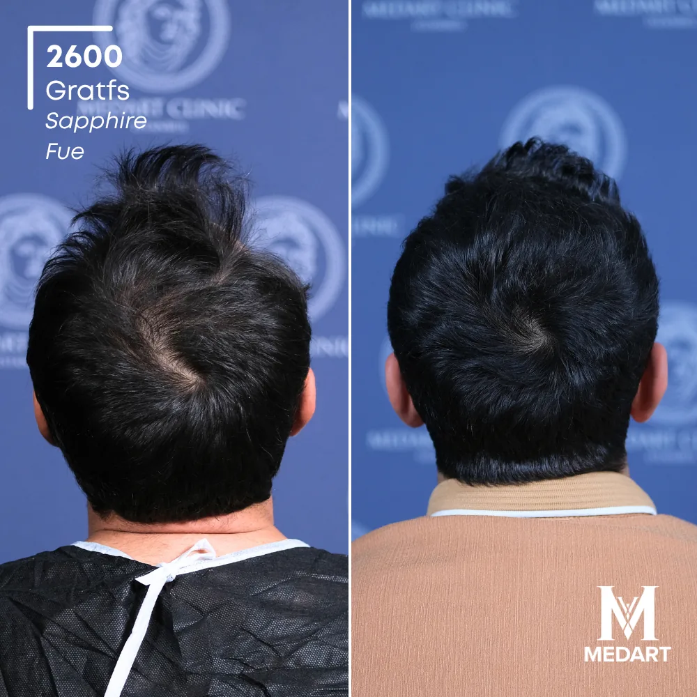 Mustafa Demirci Sapphire FUE-haartransplantatie voor-en-na-foto 5, 2600 grafts bij Medart Hair