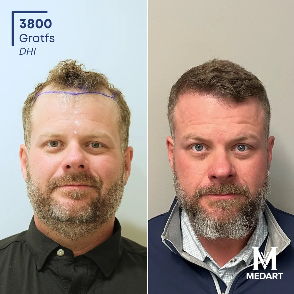 Ronny Hise DHI-haartransplantatie voor-en-na-foto 1, 3800 grafts bij Medart Hair