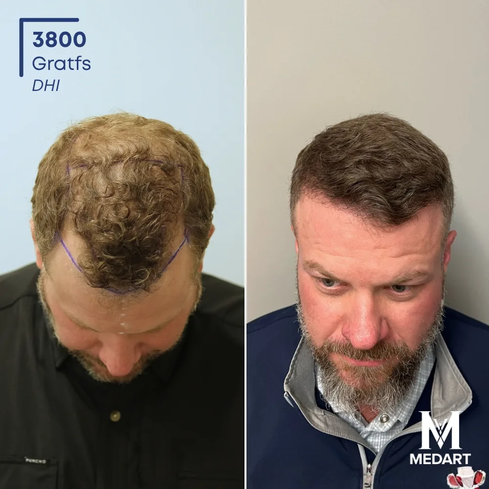 Ronny Hise DHI-haartransplantatie voor-en-na-foto 2, 3800 grafts bij Medart Hair
