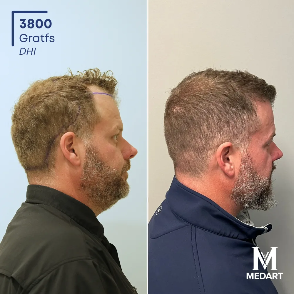 Ronny Hise DHI-haartransplantatie voor-en-na-foto 3, 3800 grafts bij Medart Hair