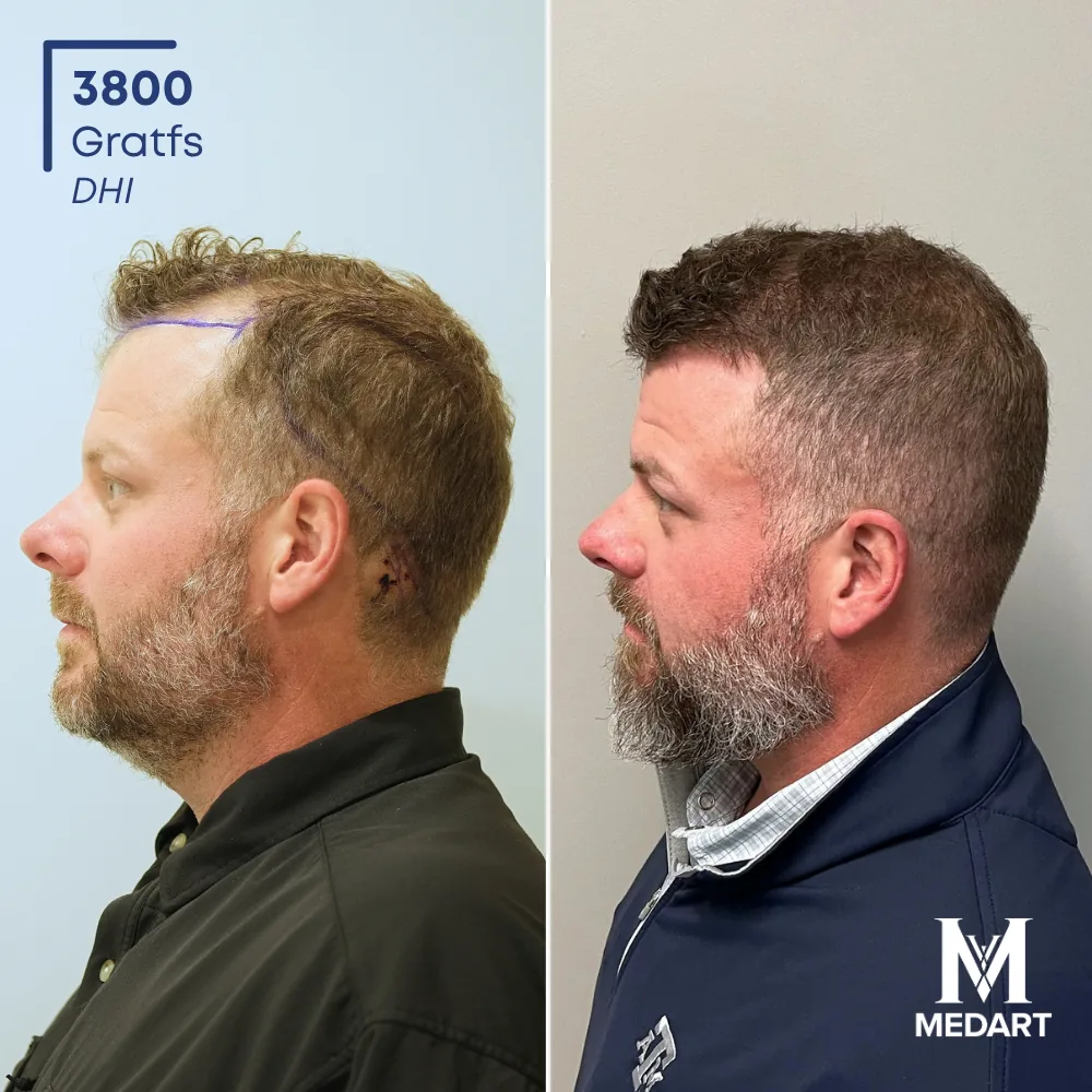 Ronny Hise DHI-haartransplantatie voor-en-na-foto 4, 3800 grafts bij Medart Hair