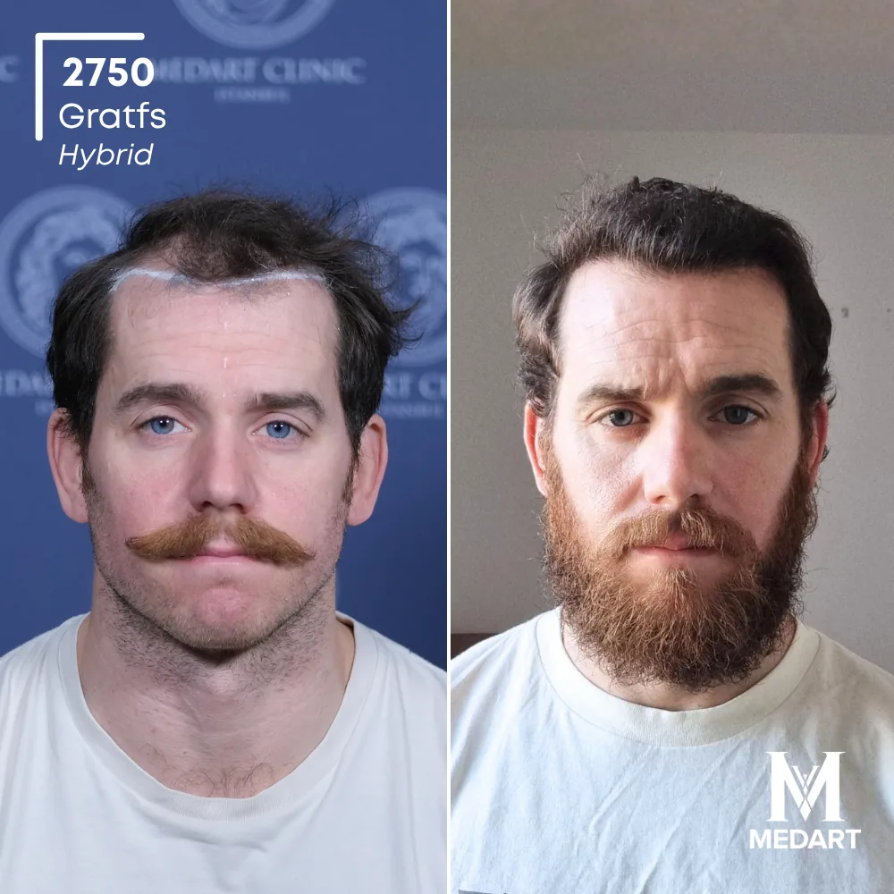 Ryan Hybride haartransplantatie voor-en-na-foto 1, 2750 grafts bij Medart Hair