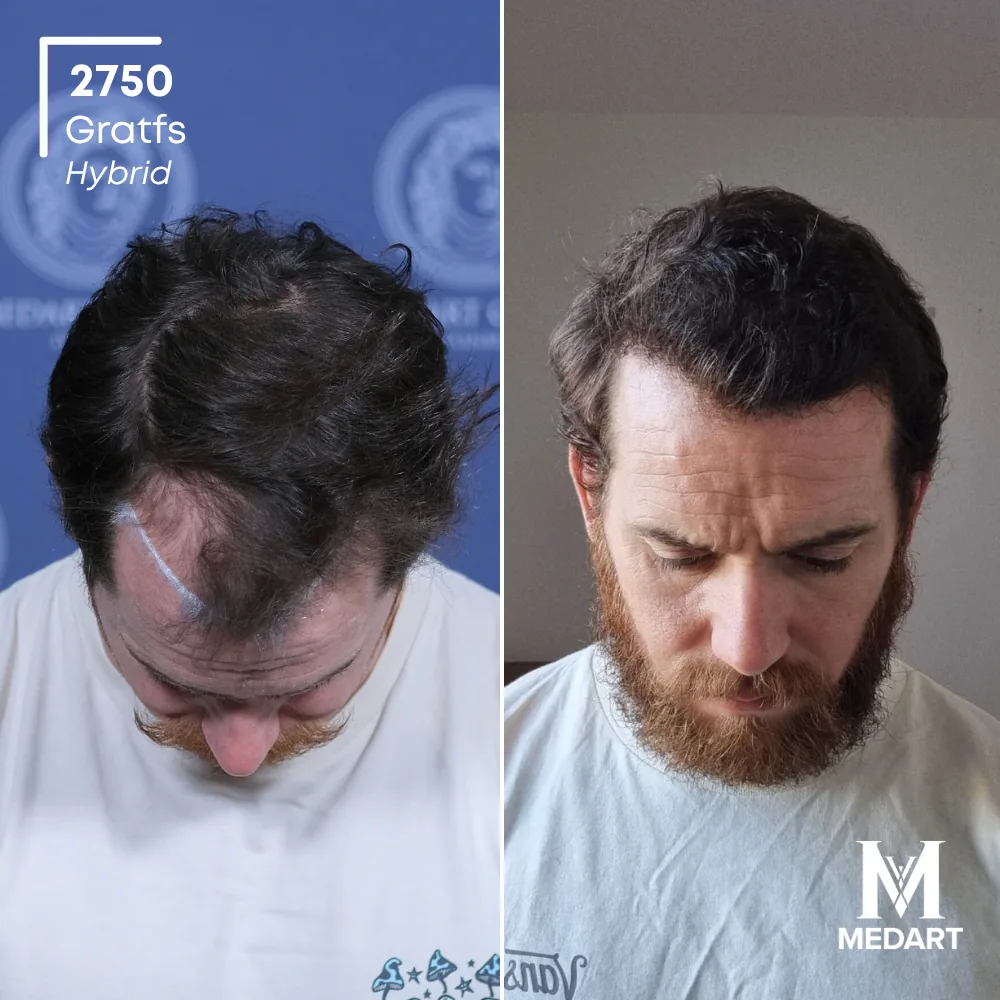Ryan Hybride haartransplantatie voor-en-na-foto 2, 2750 grafts bij Medart Hair