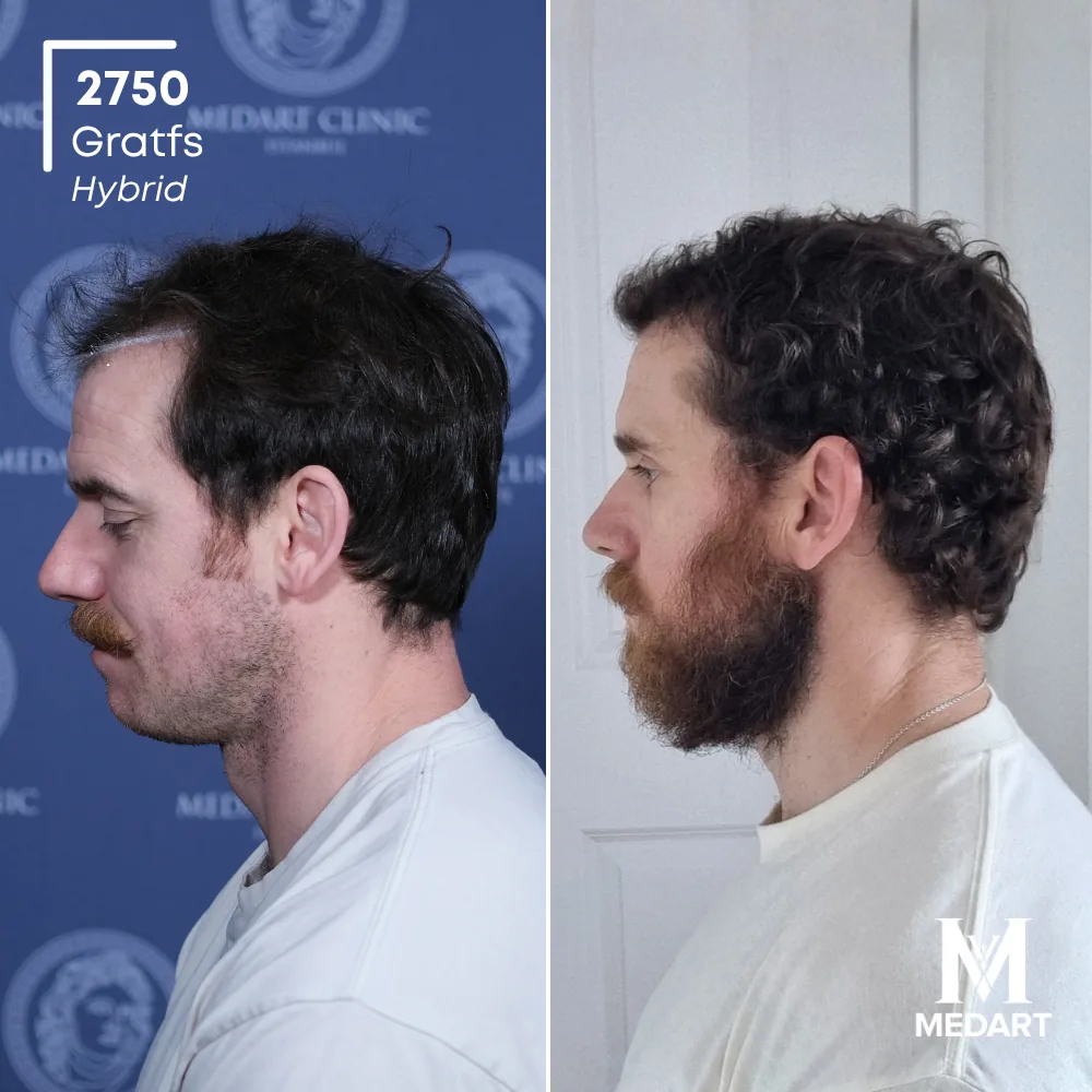 Ryan Hybride haartransplantatie voor-en-na-foto 3, 2750 grafts bij Medart Hair