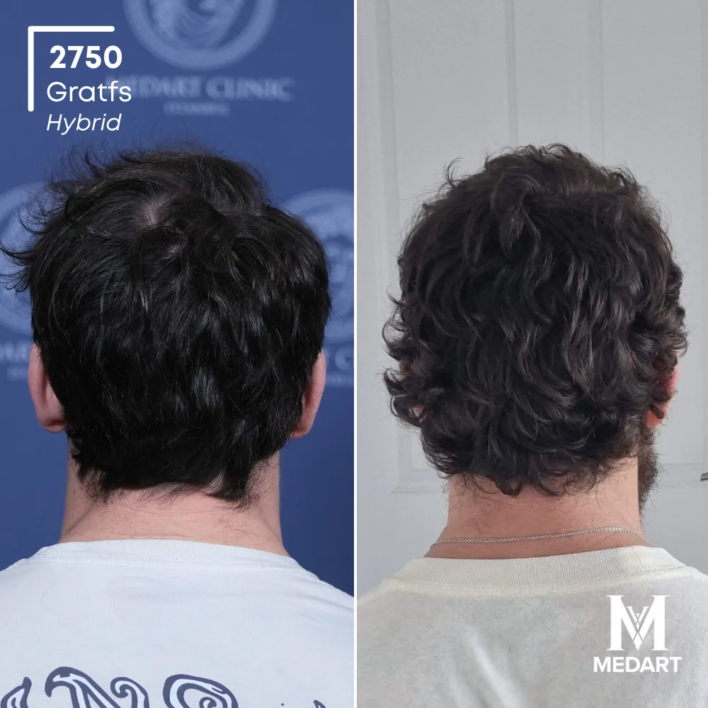 Ryan Hybride haartransplantatie voor-en-na-foto 4, 2750 grafts bij Medart Hair