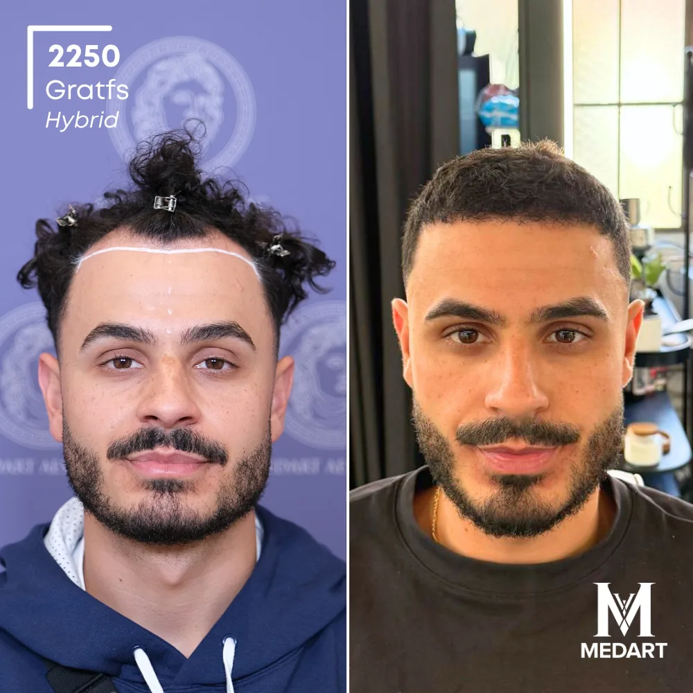 Tasso Hybride haartransplantatie voor-en-na-foto 1, 2250 grafts bij Medart Hair