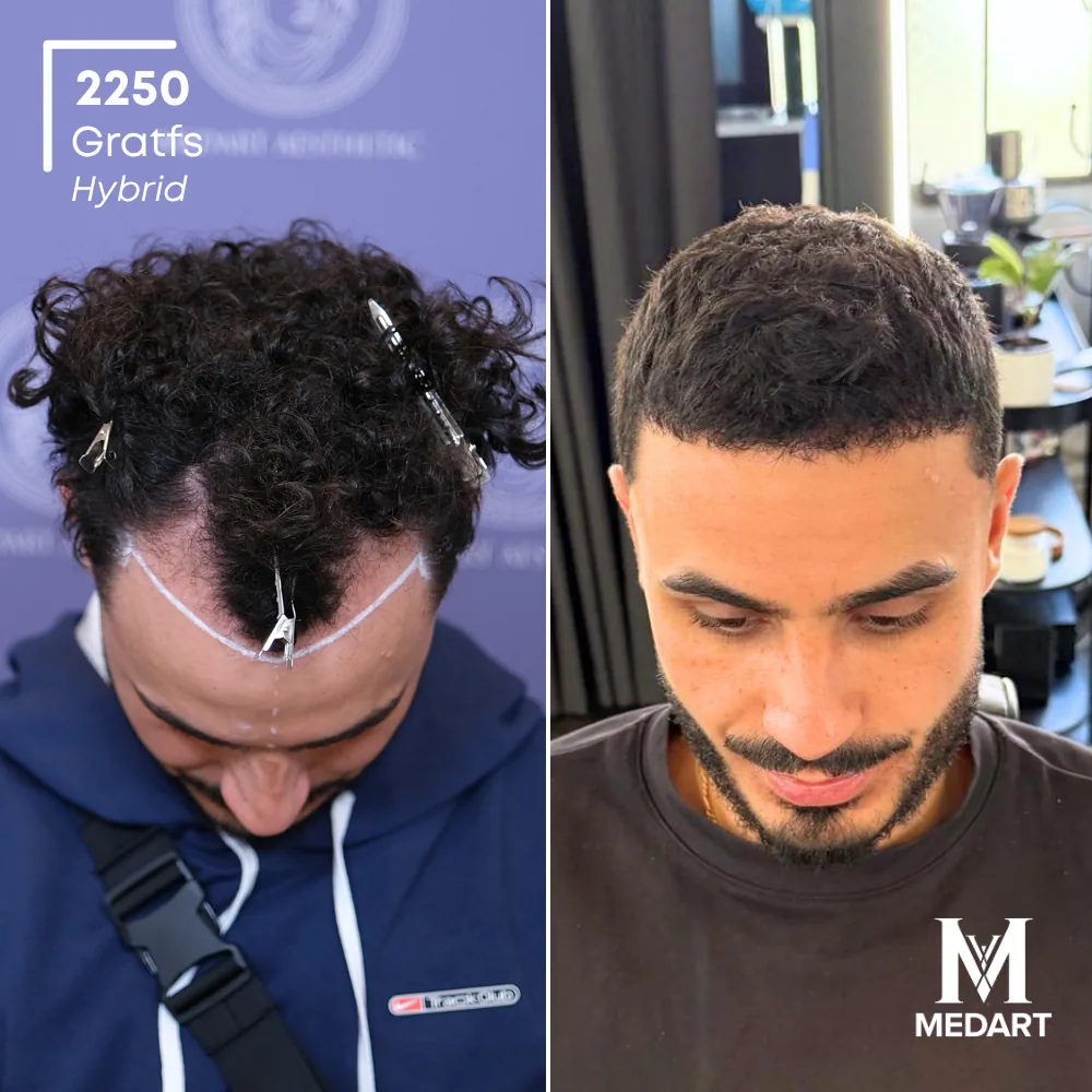 Tasso Hybride haartransplantatie voor-en-na-foto 2, 2250 grafts bij Medart Hair