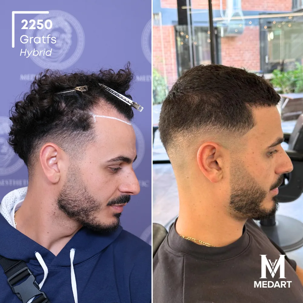 Tasso Hybride haartransplantatie voor-en-na-foto 3, 2250 grafts bij Medart Hair