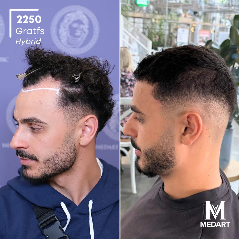 Tasso Hybride haartransplantatie voor-en-na-foto 4, 2250 grafts bij Medart Hair