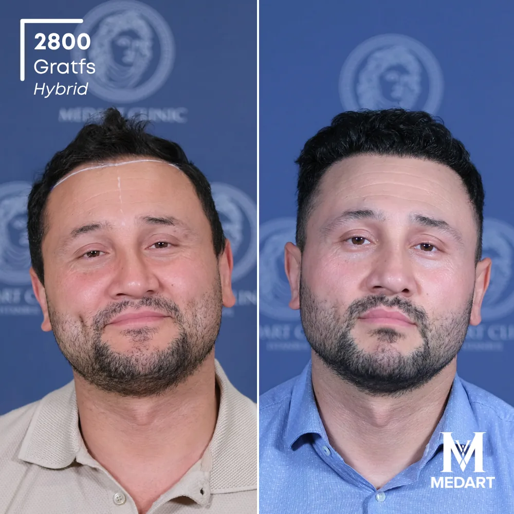 Tolgay Yazar Hybride haartransplantatie voor-en-na-foto 1, 2800 grafts bij Medart Hair