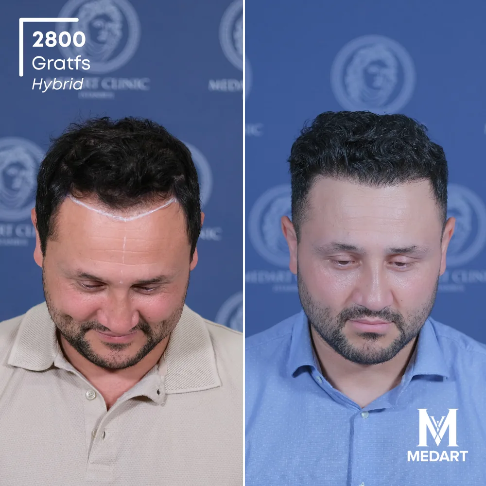 Tolgay Yazar Hybride haartransplantatie voor-en-na-foto 2, 2800 grafts bij Medart Hair