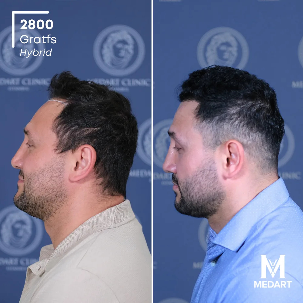 Tolgay Yazar Hybride haartransplantatie voor-en-na-foto 3, 2800 grafts bij Medart Hair