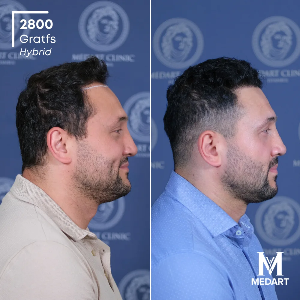 Tolgay Yazar Hybride haartransplantatie voor-en-na-foto 4, 2800 grafts bij Medart Hair