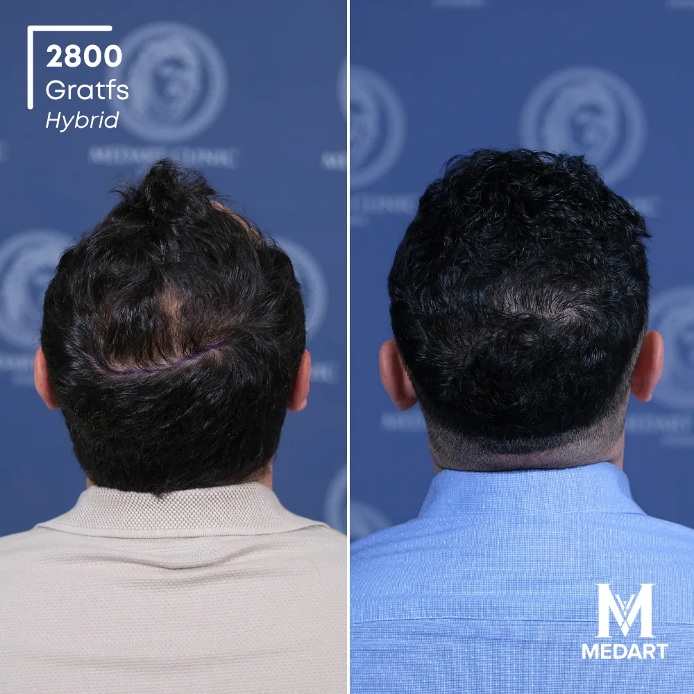 Tolgay Yazar Hybride haartransplantatie voor-en-na-foto 5, 2800 grafts bij Medart Hair