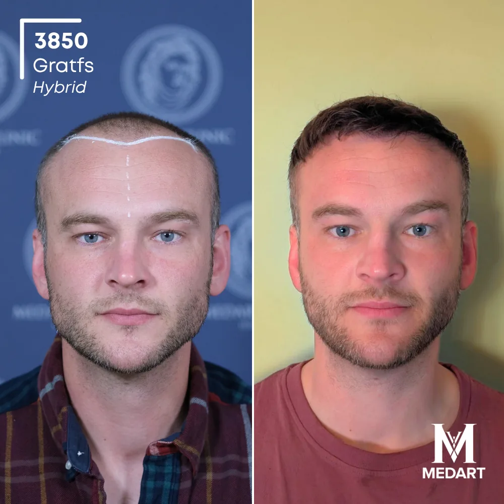 Tommo John Hybride haartransplantatie voor-en-na-foto 1, 3850 grafts bij Medart Hair