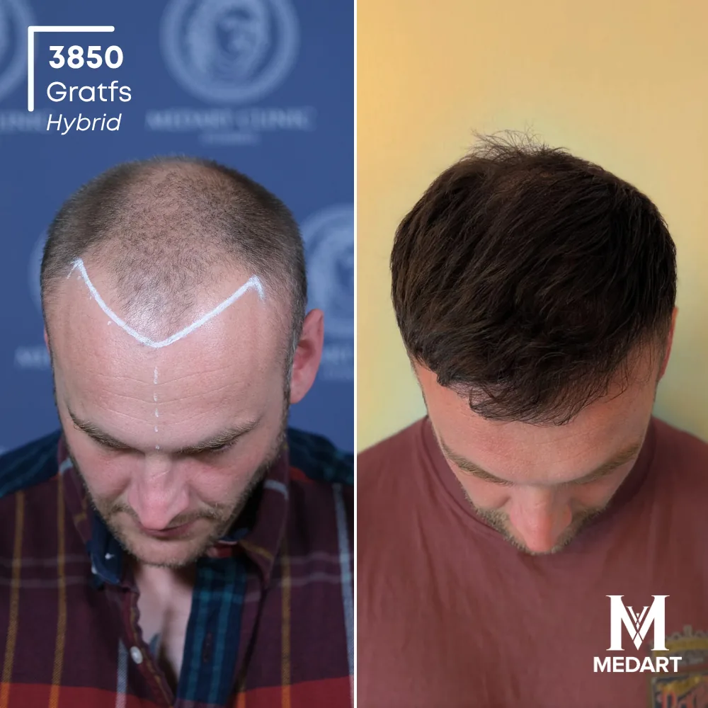 Tommo John Hybride haartransplantatie voor-en-na-foto 2, 3850 grafts bij Medart Hair
