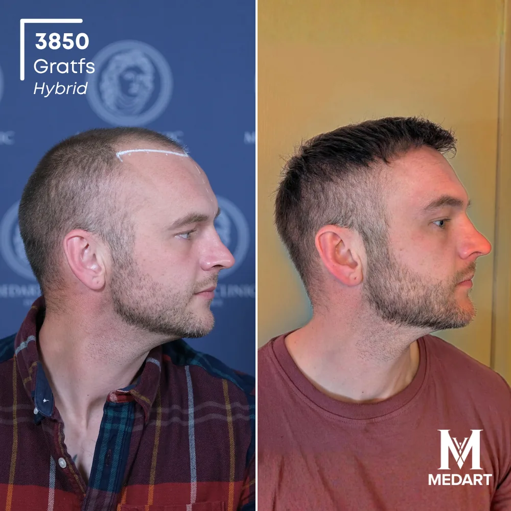 Tommo John Hybride haartransplantatie voor-en-na-foto 3, 3850 grafts bij Medart Hair