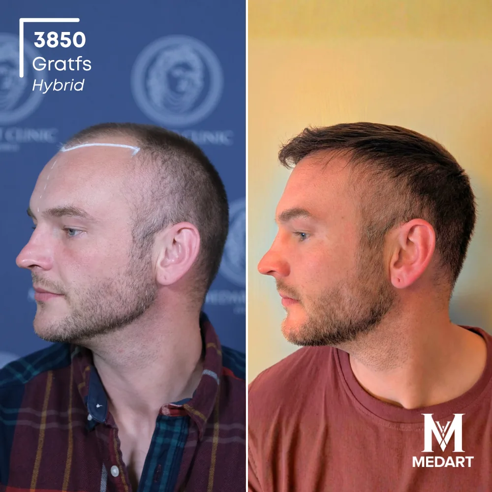 Tommo John Hybride haartransplantatie voor-en-na-foto 4, 3850 grafts bij Medart Hair