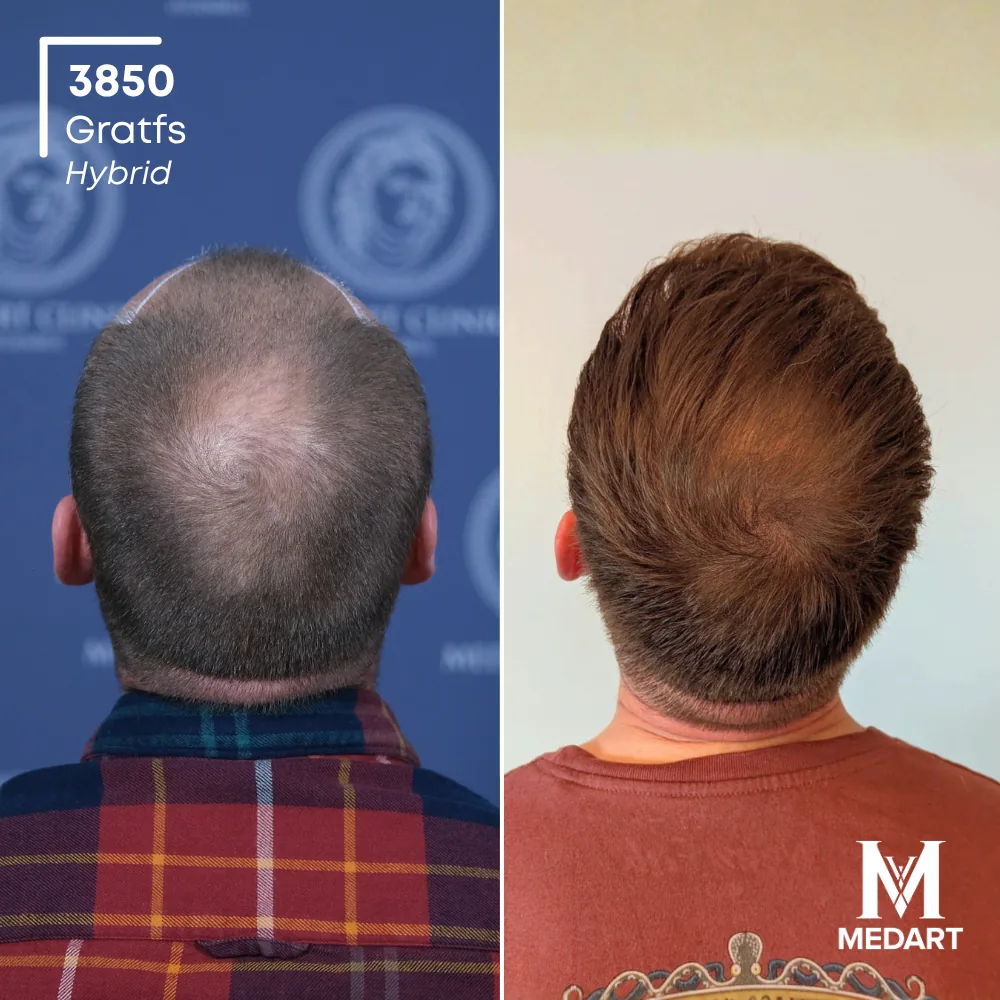 Tommo John Hybride haartransplantatie voor-en-na-foto 5, 3850 grafts bij Medart Hair